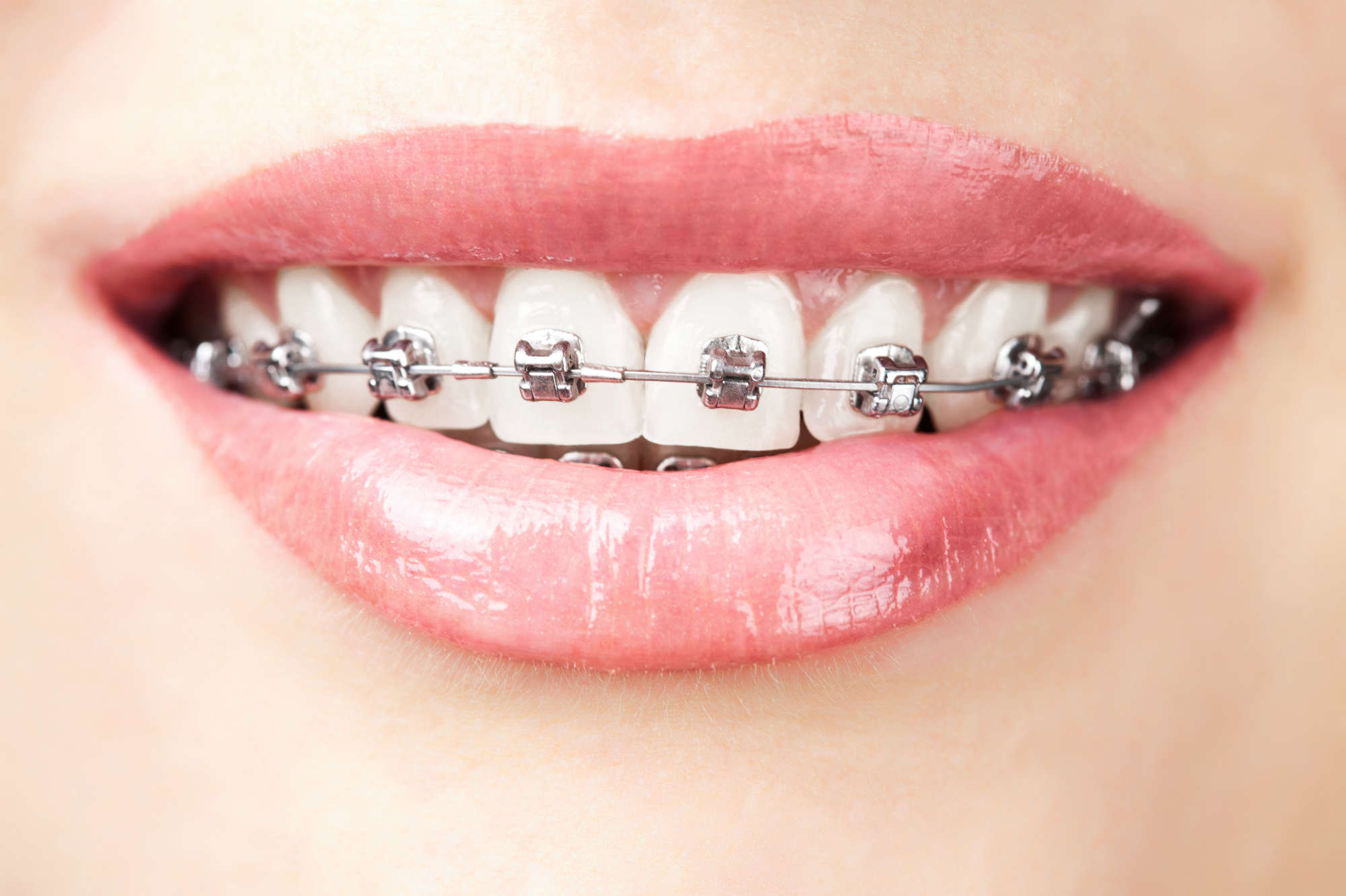 Braces